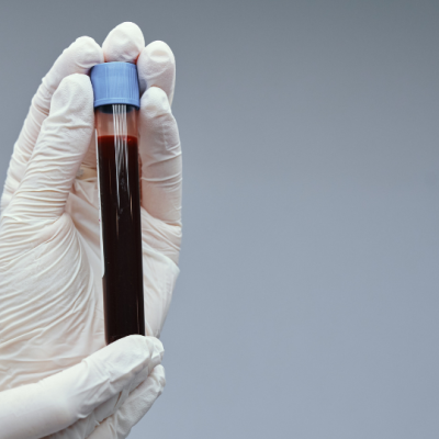 New methods for biomarker discovery from microsampled whole blood of cancer patients